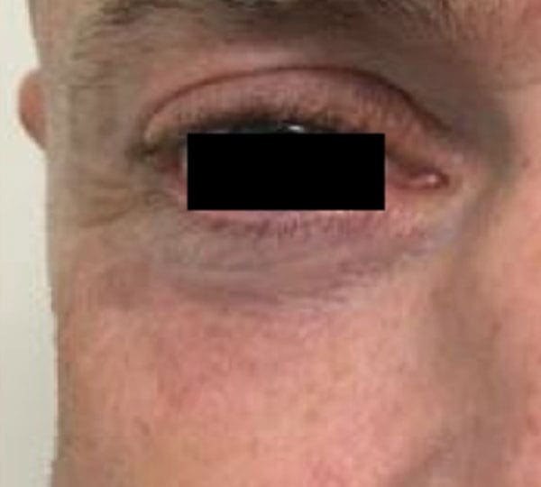 plexr treatment after