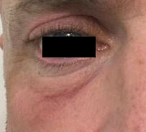 plexr treatment before