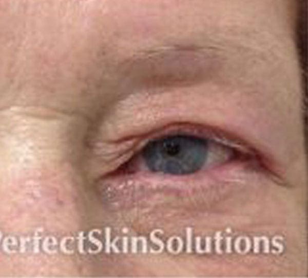 plexr treatment after