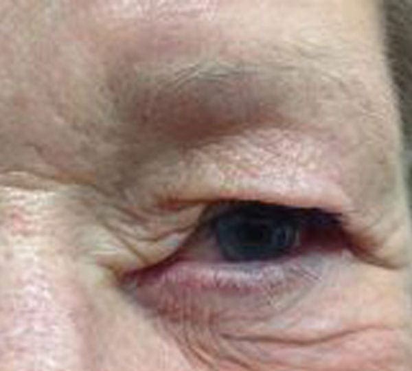 plexr treatment before