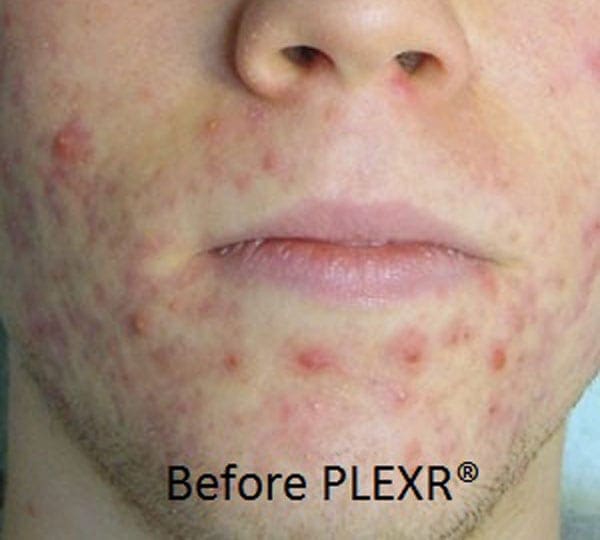 plexr plus treatment before