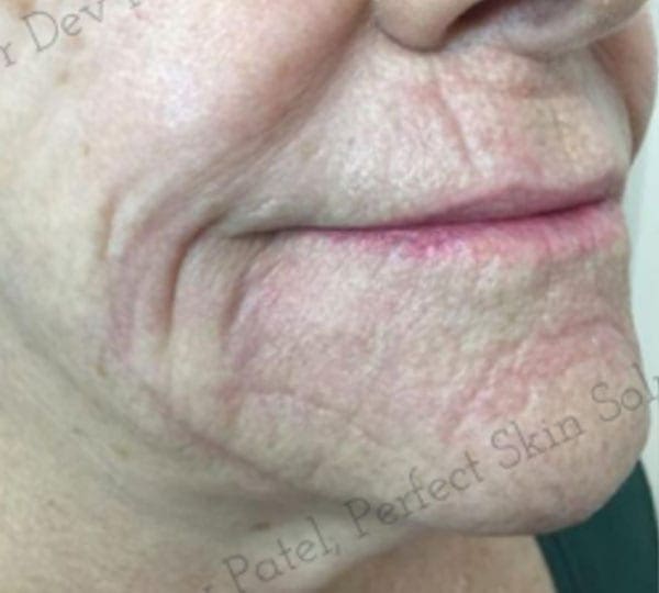 skin tightening after