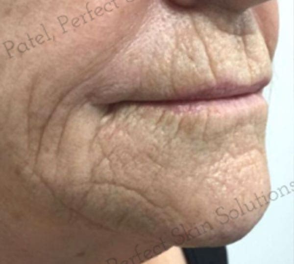 skin tightening treatment before