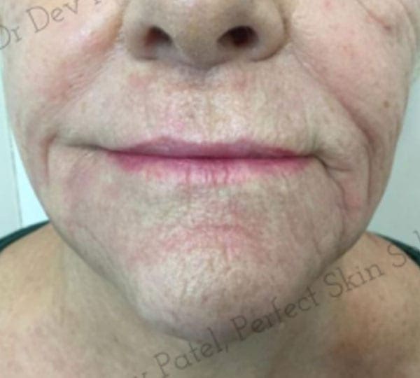 skin tightening treatment after