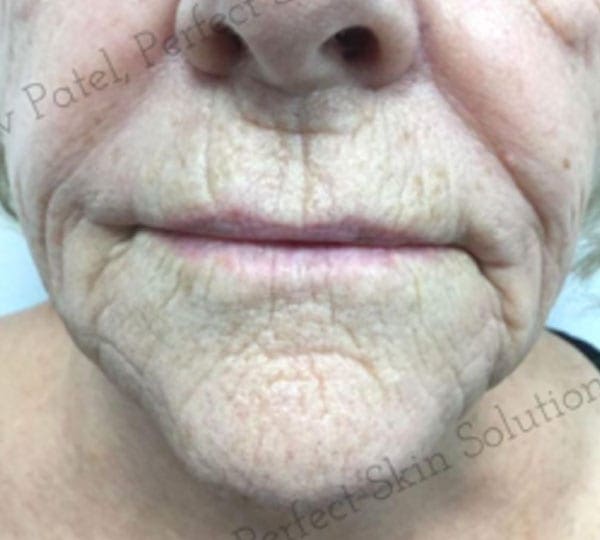 skin tightening treatment before