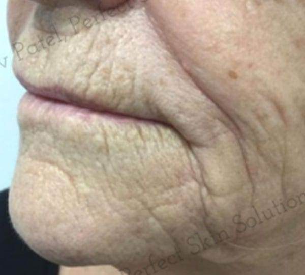 skin tightening treatment before