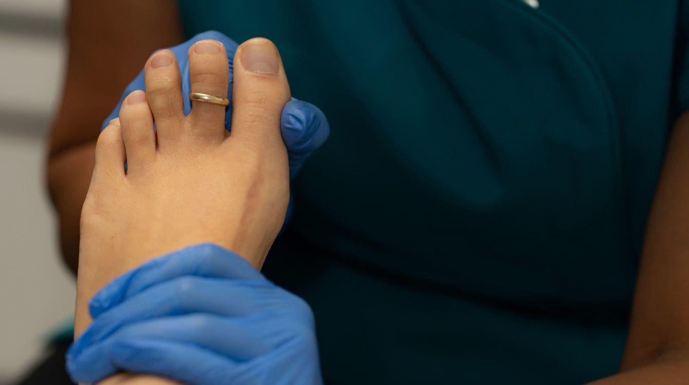 dry needling verruca removal treatment