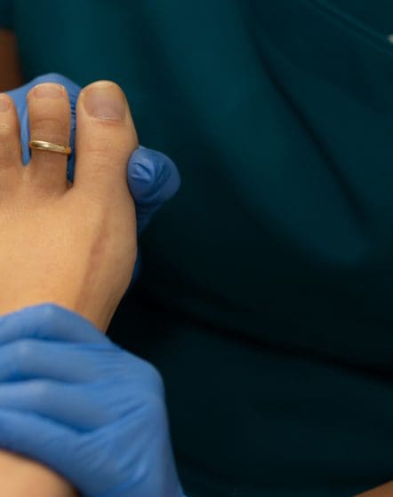 dry needling verruca removal treatment