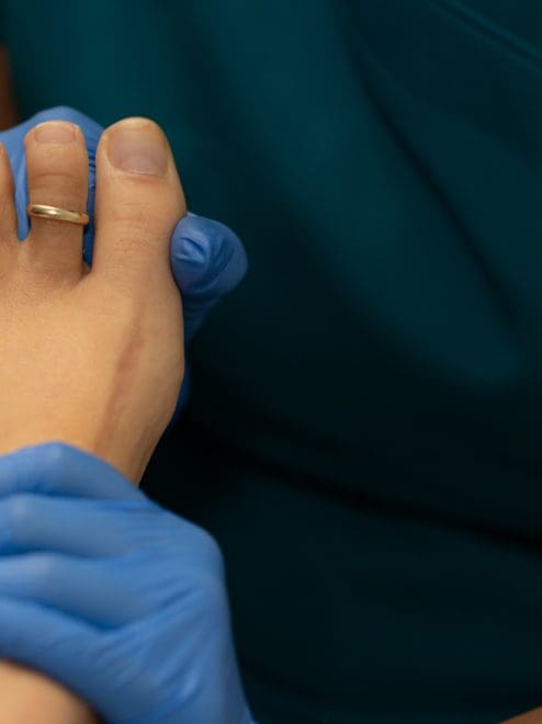 dry needling verruca removal treatment