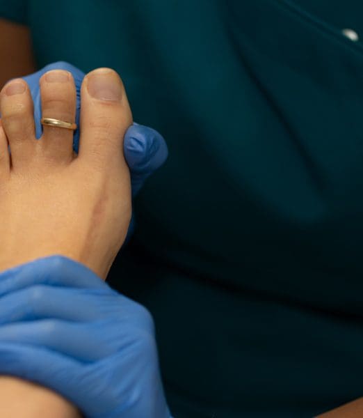 Verruca Removal Laser with UltraClear: The Modern Solution for Stubborn Warts