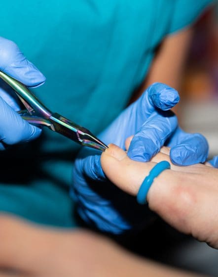 nail surgery on ingrown toenail