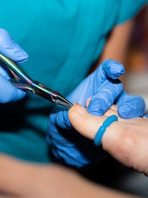 nail surgery on ingrown toenail