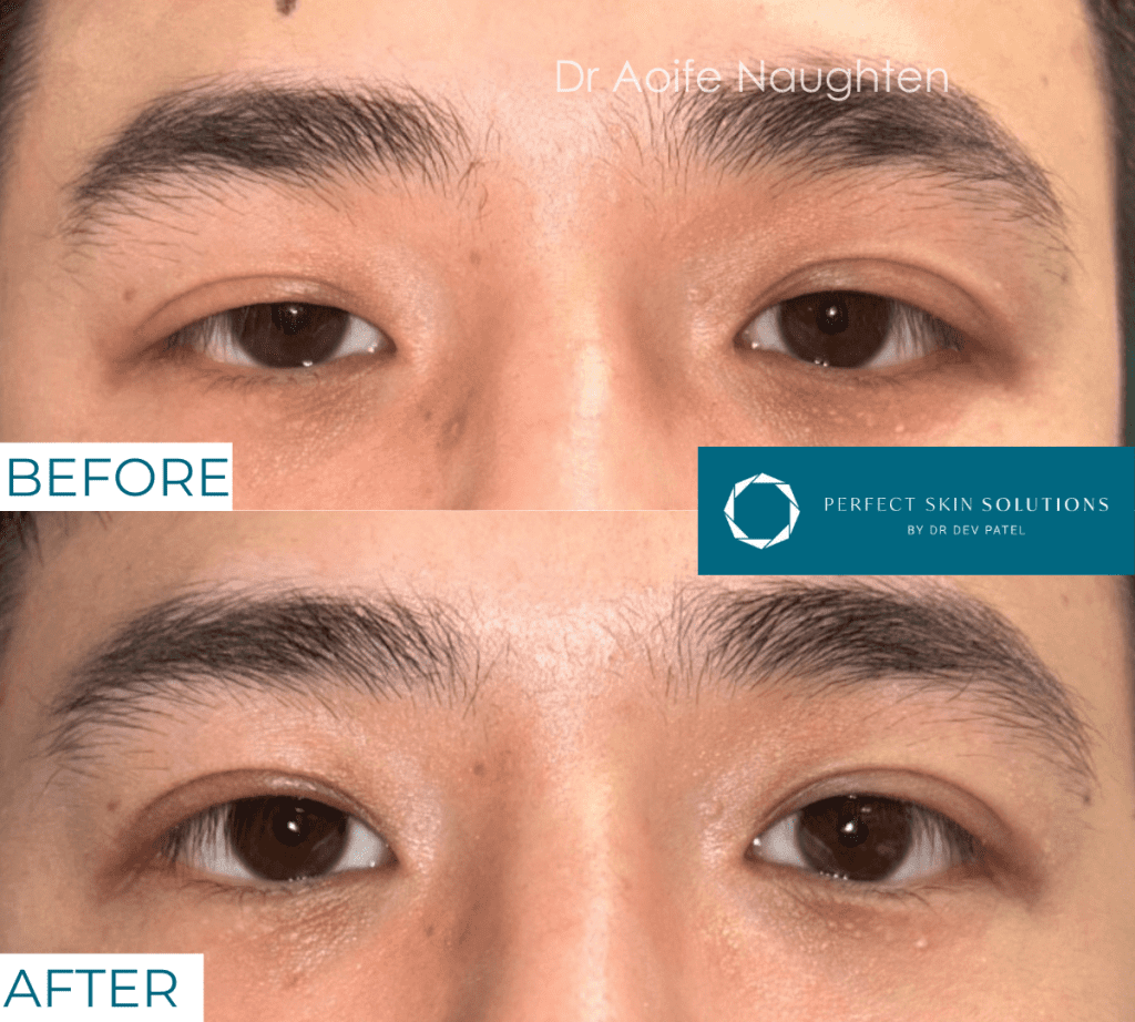 eyelid surgery