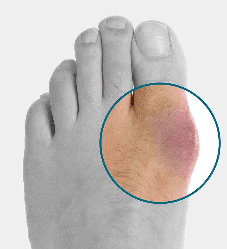 Psoriasis and psoriatic arthritis on the feet