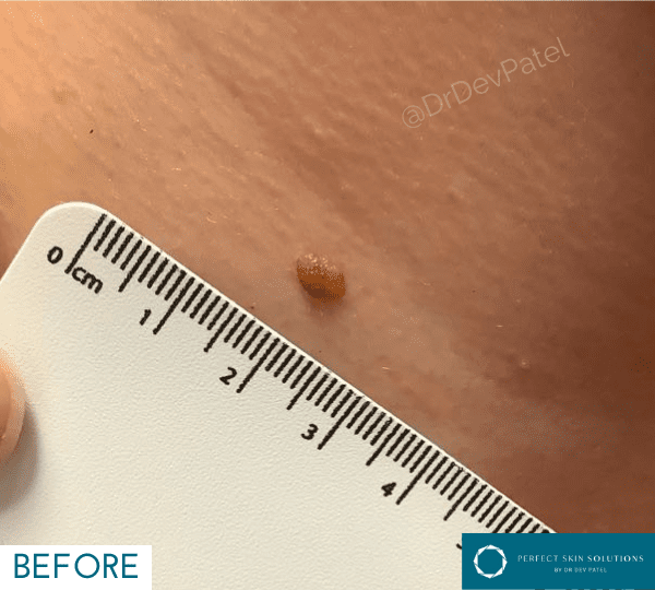 skin surgery treatment before