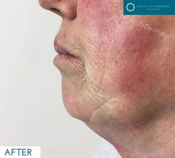 Chin filler treatment, before image