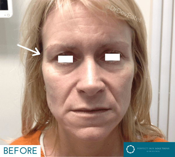 Temple and forehead fillers before