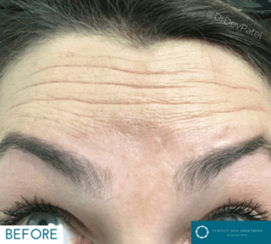 A woman with botox injections