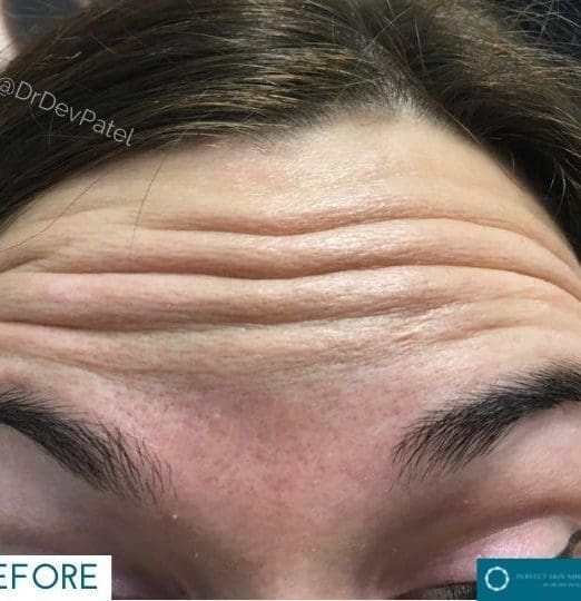 Best Treatment for Wrinkles on Forehead: Expert Solutions at Perfect Skin Solutions