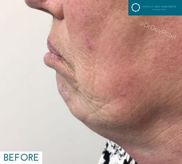 Chin filler treatment, before image