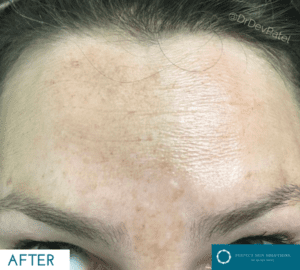 A woman with botox injections