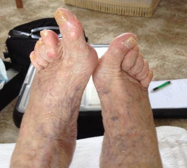 chiropody treatment after