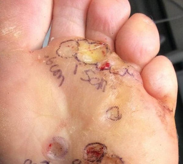 foot treatment after