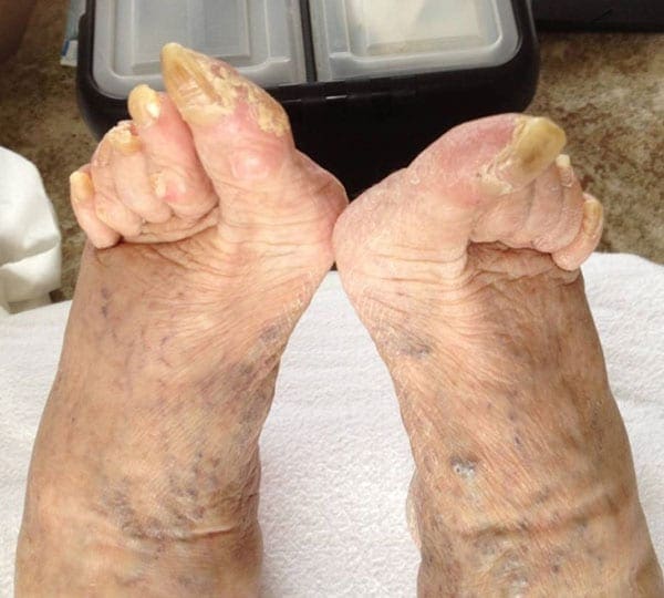 chiropody treatment before