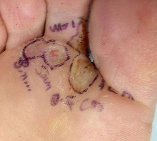 foot treatment before