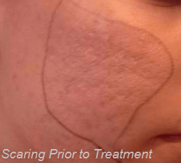 microneedling before
