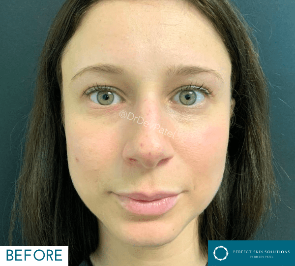 dermal filler treatment before