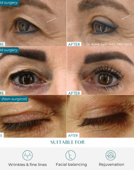 eyelid lift options
