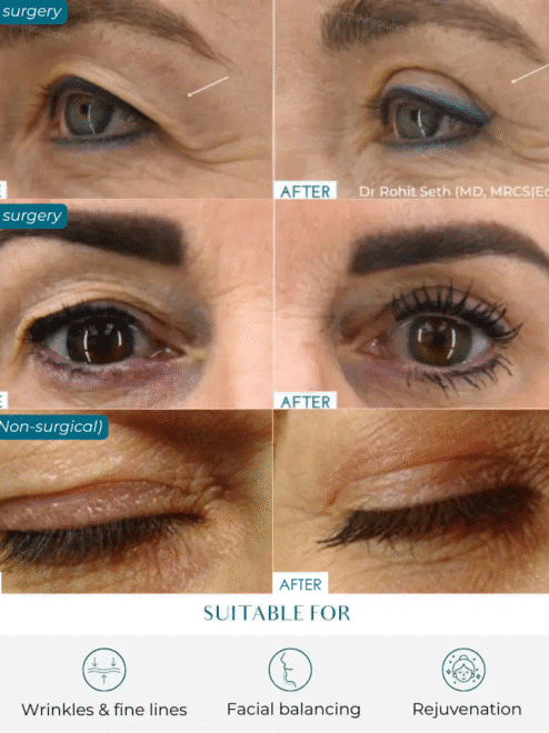 eyelid lift options