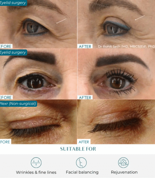 Eyelid Lift