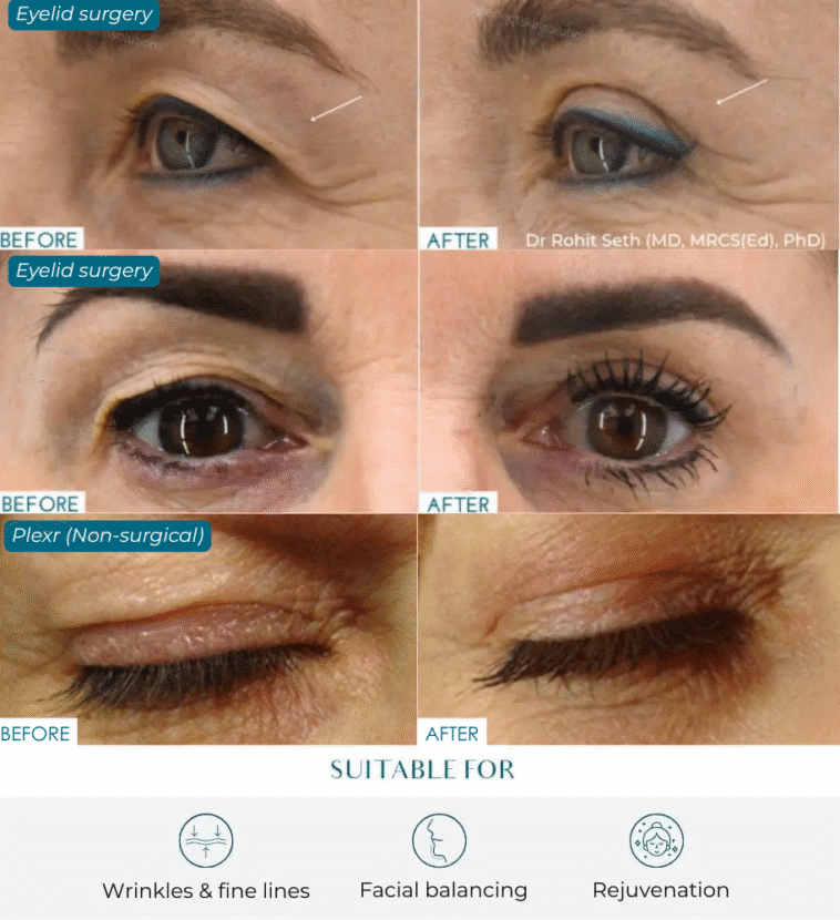 eyelid lift options