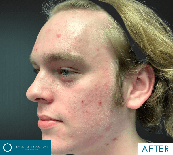 rf microneedling treatment after