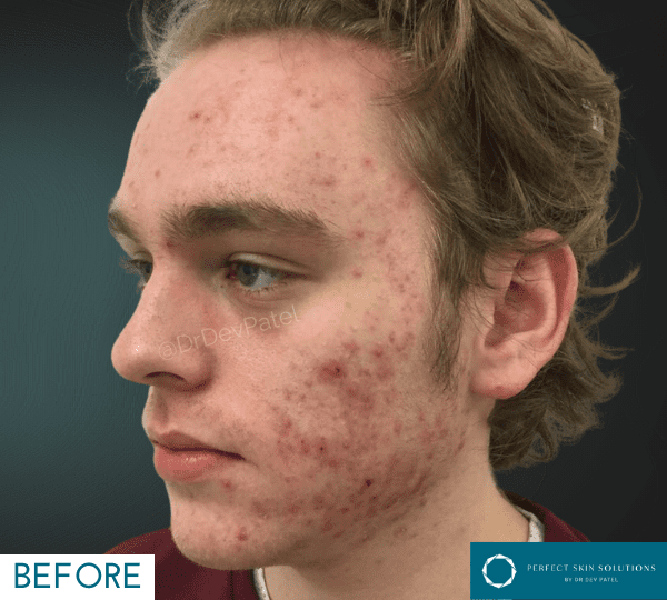 rf microneedling treatment before