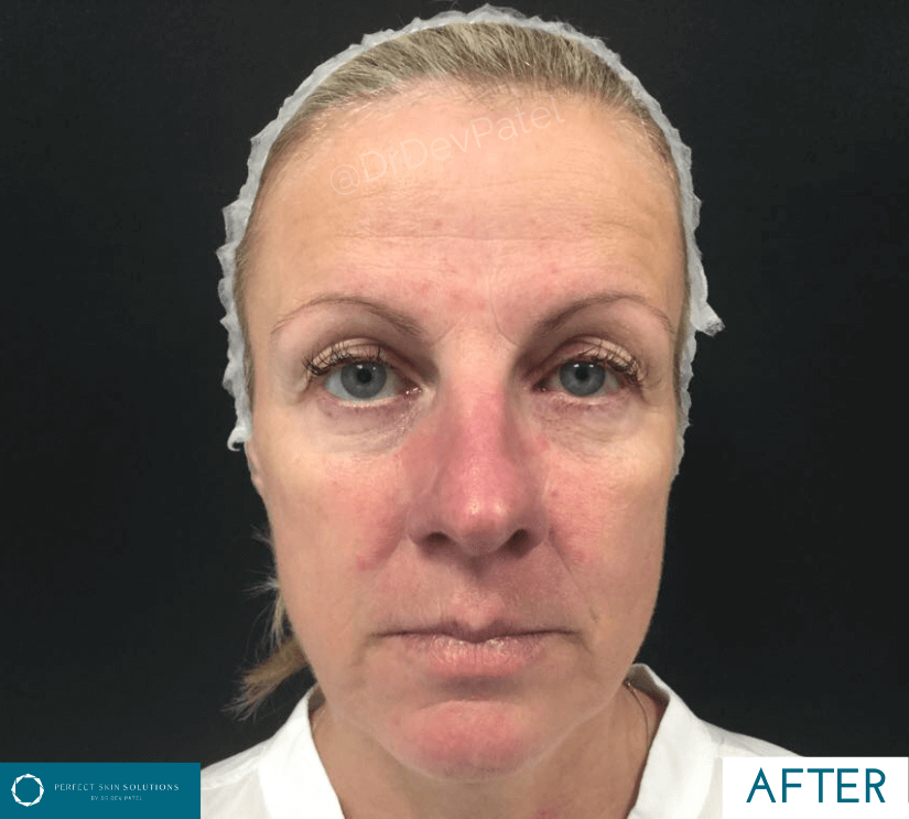 intense pulse light treatment after