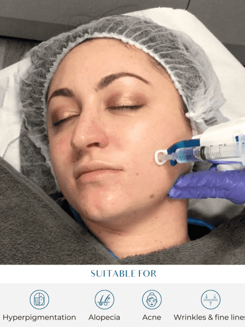 mesotherapy