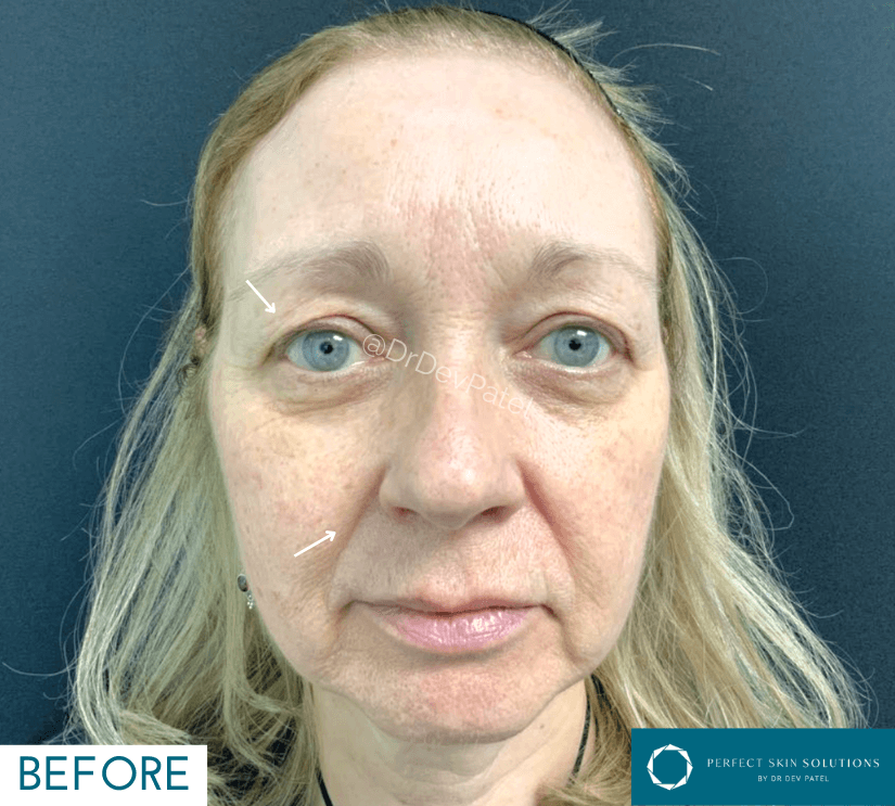 picture of a patient before lumecca treatment