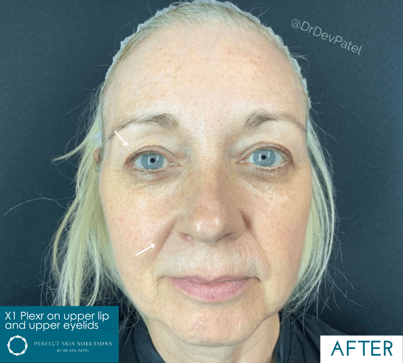 lumecca patient after treatment