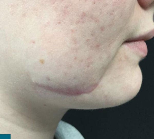 iprf treatment after