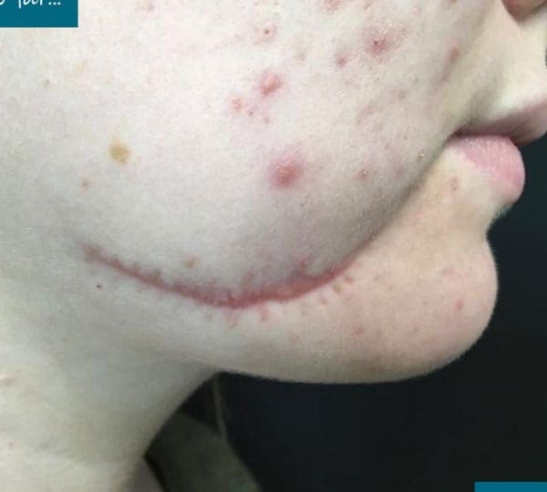 iprf treatment before