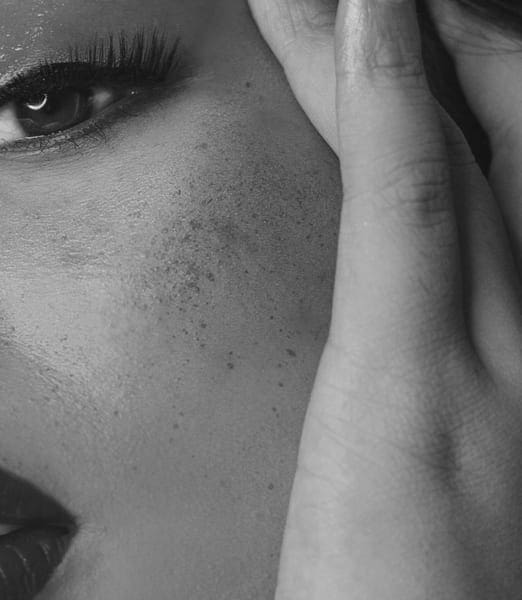 Dermatology Treatment for Hyperpigmentation: Your Guide to Clearer, Brighter Skin