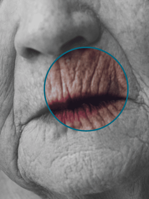 smoker's lines highlighted on a model