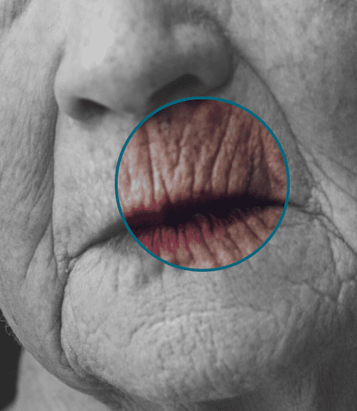 How Smoking Lines Filler Can Transform Your Smile: Expert Insights from Perfect Skin Solutions