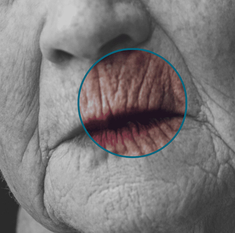 smoker's lines highlighted on a model