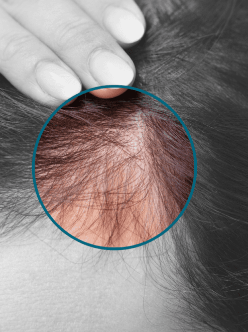 signs of hair loss