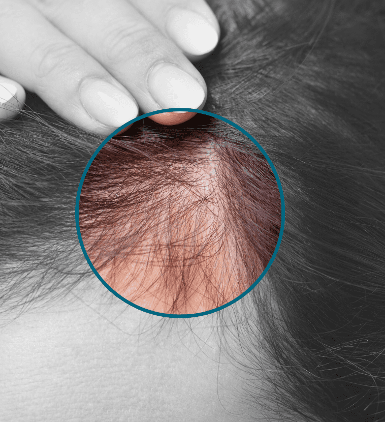 Hair Loss Treatment Portsmouth - Alopecia - Perfect Skin