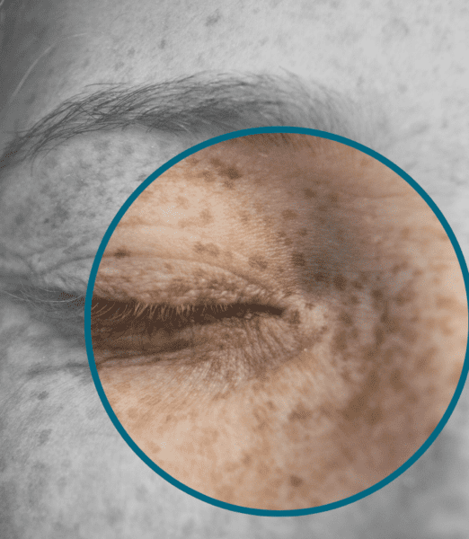 Understanding Pigmentation on Neck: Causes & Treatment Options